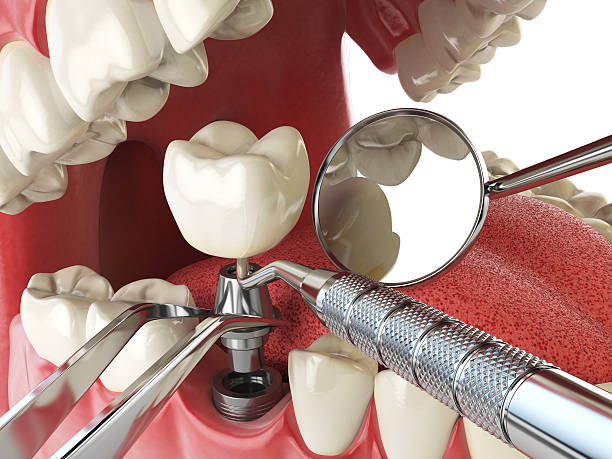 Best Emergency Treatment for Dental Infections or Abscesses in Plymouth, IN